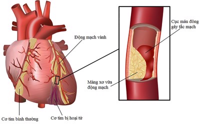 Cải thiện biến chứng tăng huyết áp lên tim bằng sản phẩm thảo dược